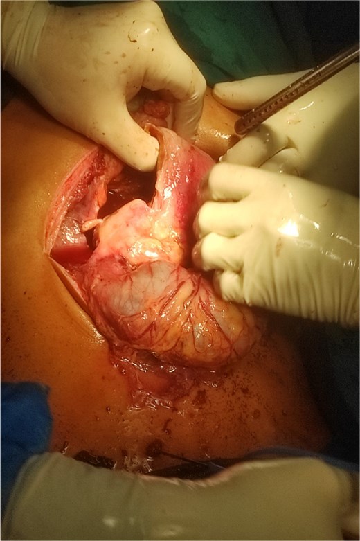 Intraoperative image showing gastroduodenal perforation and spillage of hemorrhagic content.