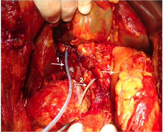 Intraoperative image showing placements of T-tube in common bile duct (1) and pancreatic drain in pancreatic duct (2). Gastrojejunal anastomosis is also visible (3).