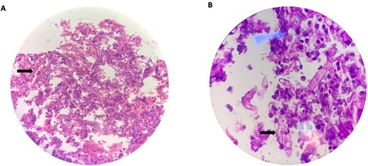 High power (40 X) view (A) and oil immersion high power (100 X) view (B) of broad ribbon like aseptate branching hyphae (arrows) seen with Periodic acid-Schiff (PAS) stain making an angle around 90° or greater consistent for microscopic features of mucormycosis.