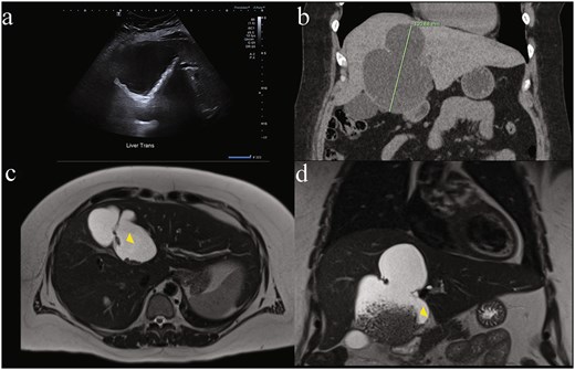 Diagnostic difficulty represented in single patient imaging series of mucinous cystic neoplasm of the liver (MCN-L). There is wide variation between modalities in same patient: (a) ultrasound of liver demonstrating internal matrix echogenicity or debris, (b) coronal contrast enhanced CT showing non-enhancing cystic lesion 12.1 cm in largest dimension occupying most of segment IV a and b with internal debris, peripheral calcifications and left hepatic lobe biliary tree dilatation reported as concerning for biliary cystadenoma, and magnetic resonance imaging (MRI) T2-weighted. (c) Axial and (d) coronal views showing dependent debris with characteristic ‘hydatid sand’ (yellow arrowhead) appearance and septations concerning for hydatid disease that were later found to be bile stones.