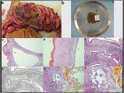 Histopathologic examination: (a and b) initial sectioning for fixation showed a large multilocular cystic lesion with numerous tan calculi and biliary debris in the lumen, (c and d) the internal surface of the largest locule predominantly had a green-tinged roughened texture, corresponding to microscopic bile encrustation and denuded epithelium (*) with sclerosis of the cyst wall. The intact epithelium, well preserved in adjacent smaller locules (#), was cuboidal to columnar mucinous epithelium with (e) ovarian-like subepithelial stroma exhibiting strong positivity for (f) PR immunohistochemistry. (g and h) There was focal luminal suppurative inflammation and biliary calculi(‡)/debris seen microscopically as well as focal high-grade dysplasia and papillary tufting. No invasive component was present.
