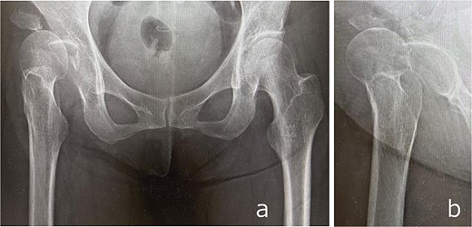 Anteroposterior (a) and lateral (b) radiographs of the right hip obtained at initial presentation, demonstrating anterior hip dislocation associated with acetabular and anterior inferior iliac spine fractures.