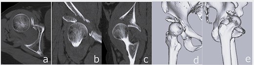 CT images obtained at initial presentation: Axial (a), coronal (b), and sagittal (c) views, as well as three-dimensional reconstructions (d and e), showing anterior hip dislocation with fractures of the acetabular anterior wall and anterior inferior iliac spine.