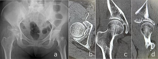Post-reduction imaging: Anteroposterior radiograph (a) and CT images (b–d) demonstrating reduction of the hip joint with an intra-articular femoral head fracture fragment and anterior acetabular wall involvement.