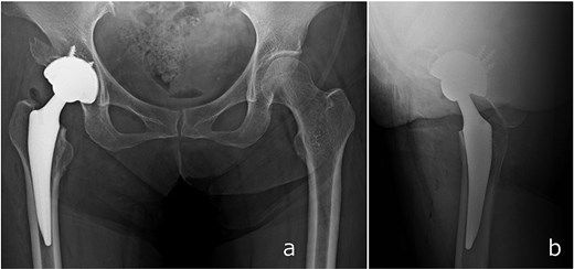 Immediate postoperative anteroposterior (a) and lateral (b) radiographs demonstrating stable placement of the total hip arthroplasty components.