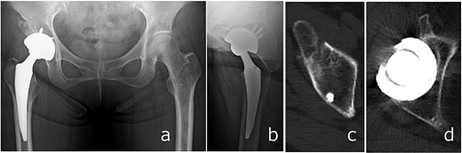 Radiographs (a and b) and CT images (c and d) obtained at 6 months postoperatively, showing stable implant fixation and partial union of the anterior inferior iliac spine and acetabular anterior wall fractures.