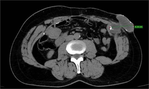 Depicting a well-encapsulated cystic lesion situated above the posterior sheath of the rectus abdominis muscle, with no communication with the bowel, measuring 6.16 cm.