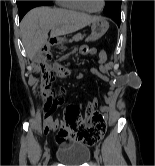 Coronal perception of CT demonstrating the lesion of the abdominal wall.