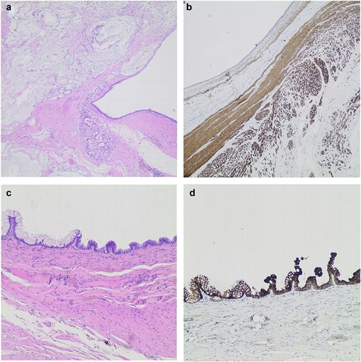 (a) Cystic mass with muscular wall disrupted by mucin (H&E ×40). (b) Two layered muscular wall highlighted by Desmin immunostain (H&E ×40). (c) Pseudopapillary epithelium with columnar pseudostratified mucus-producing cells (H&E ×100). (d) Epithelial lining diffusely positive for CK20 (H&E ×100).