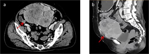 (a) Shows a cross-sectional view of the pelvic contrast-enhanced CT scan. (b) Shows a sagittal view of the pelvic contrast-enhanced CT scan.