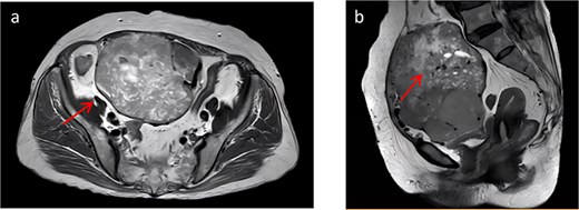 (a) Shows a cross-sectional view of pelvic contrast-enhanced MRI. (b) Shows a sagittal view of pelvic contrast-enhanced MRI.