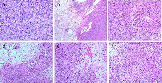(a–d) Histological features of the tumor tissue. Positive for VG and silver stains; hematoxylin and eosin (H&E) staining reveals diffuse proliferation of spindle-shaped tumor cells arranged in bundles or wheel-like patterns, abundant collagen fibers in the stroma, areas of necrosis, and mitotic figures >4 per 10 high-power fields.