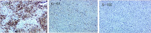 Tumor immunohistochemistry results. CD34 focal positive; Ki-67 positive rate ~20%; S-100 negative.