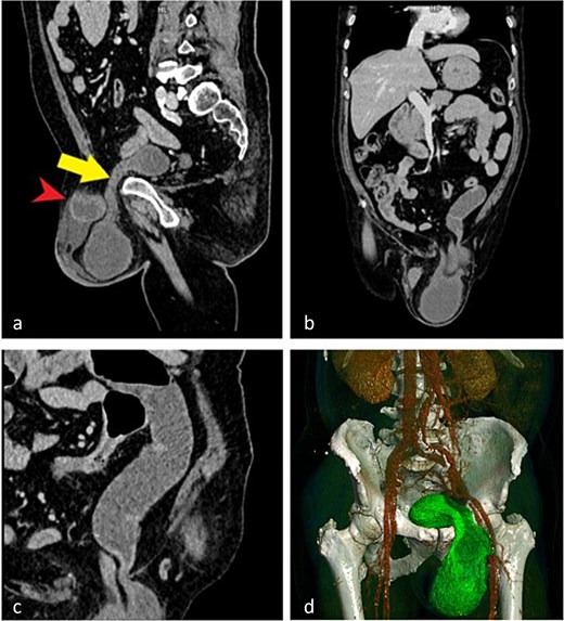 CT images demonstrating an incarcerated left inguinoscrotal hernia. (a) Sagittal plane showing herniation of the anterior bladder wall and a small bowel loop. (b) Coronal plane view of the herniated portion of the urinary bladder and small bowel. (c) Dilated small bowel loop with an air–fluid level proximal to the site of obstruction. (d) Three-dimensional reconstruction illustrating the herniated bladder.