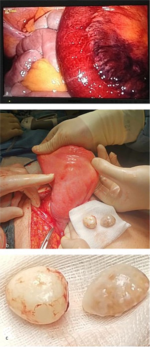 Intraoperative findings. (a) Ischemic small bowel loop identified during initial laparoscopic inspection. (b) Urinary bladder after reduction of the hernia and separation from the cord structures. (c) Two bladder calculi removed through a non-iatrogenic bladder wall defect.