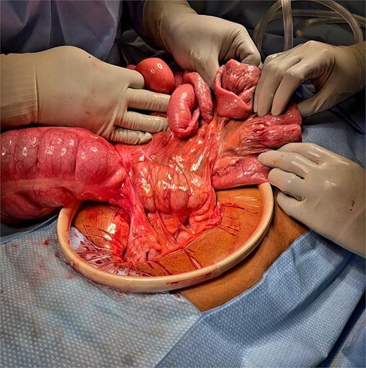 Intraoperative image demonstrating Ladd’s bands resulting in a cecal volvulus with dilated proximal small bowel and twisted cecum prior to ileocecectomy. Note the orientation of the small bowel anterior to the colon.