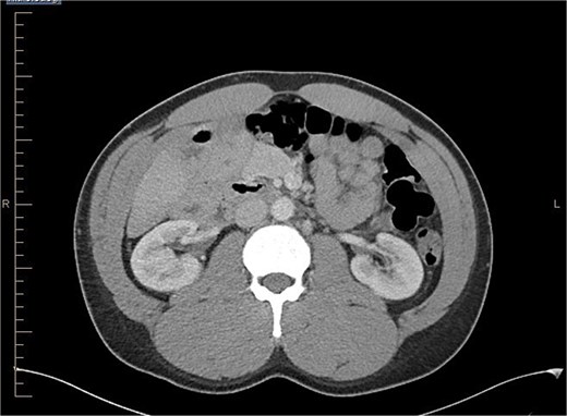 Axial view of abdominal CT scan with contrast showing the reversal of SMA and SMV.