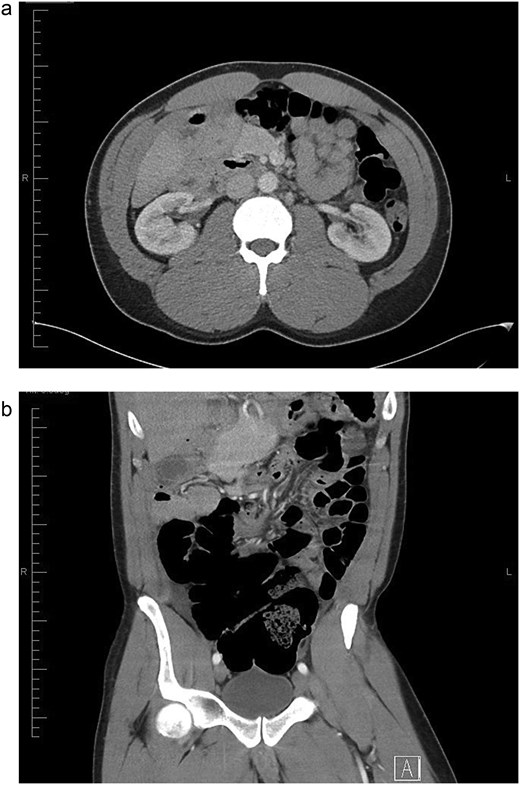 (a) Axial view of CT abdomen with contrast showing swirl sign i.e. swirling of bowel and mesentery; suggesting intestinal volvulus (superior to SMA and SMV. (b) Coronal view of CT abdomen with contrast showing swirl sign i.e. swirling of bowel and mesentery; suggesting intestinal volvulus.