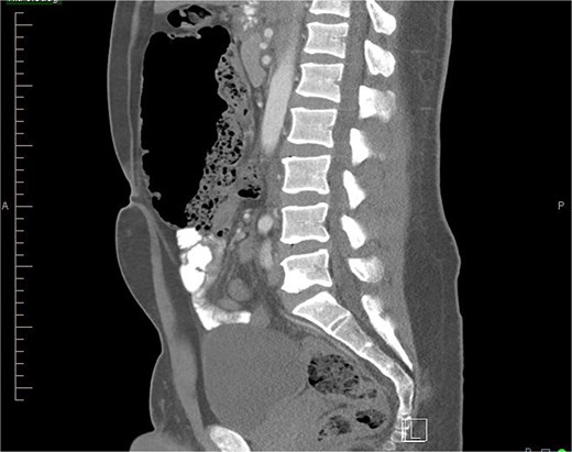 Sagittal view of CT abdomen showing higher and more anterior location of cecum; suggesting a hypermobile cecum (Normally the cecum is located lower in the right lower quadrant).
