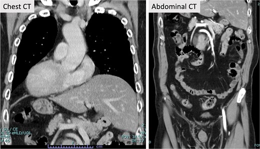 Contrast-enhanced CT. Contrast-enhanced CT revealed SIT. Other abnormalities in the blood vessels were not evident in the chest and abdomen.