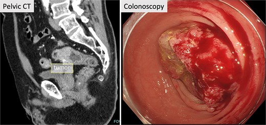 Pelvic CT and colonoscopy. Pelvic CT showed a tumor in the upper rectum, and rectal stenosis with the tumor was observed in colonoscopy.