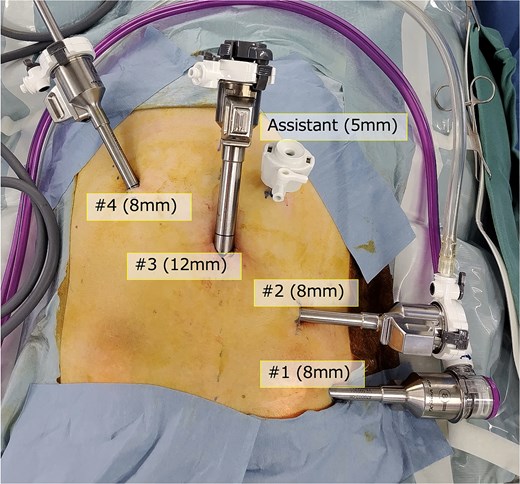 Port position. Five ports including the assistant trocar were arranged in the mirror setting of conventional RAS.