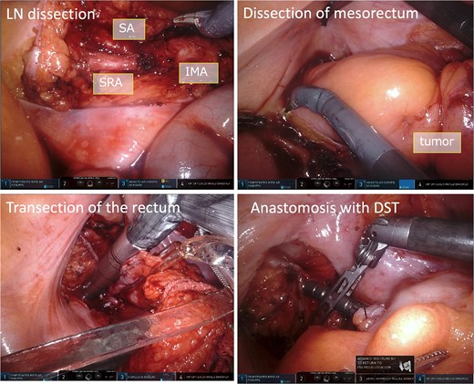 Intraoperative images. The IMA, SRA, and SA were exposed and lymph node dissection was done. The mesorectum was dissected and mobilized. To transect the rectum, we used the robotic linear stapler, and anastomosis was performed using DST.