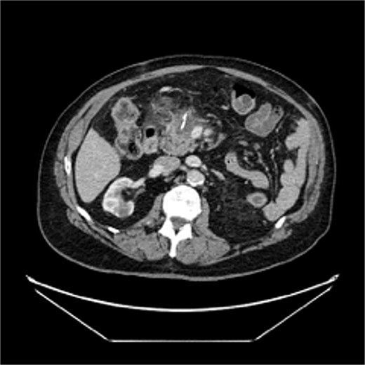 Postoperative CT demonstrating a small fluid collection in the pancreatic resection bed containing a radiopaque structure (reinforced staple line).