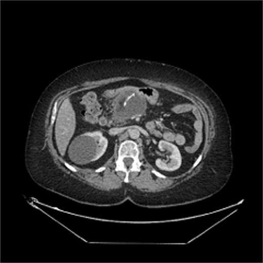 CT in Case 2 showing a postoperative collection with an apparent free-floating radiopaque object within the cavity.
