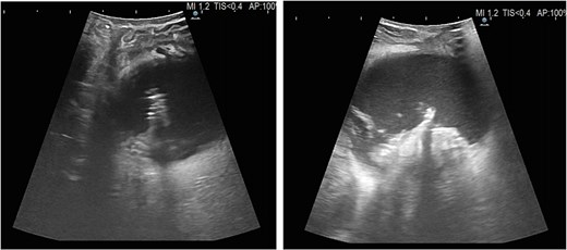 Intraoperative ultrasound demonstrating the characteristic acoustic shadow and shape of the staple line within the encapsulated collection.