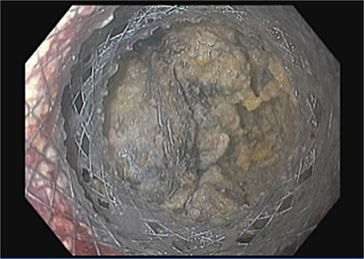 Endoscopic view during cystogastrostomy creation demonstrating the staple line within the collection, confirming expected surgical material.