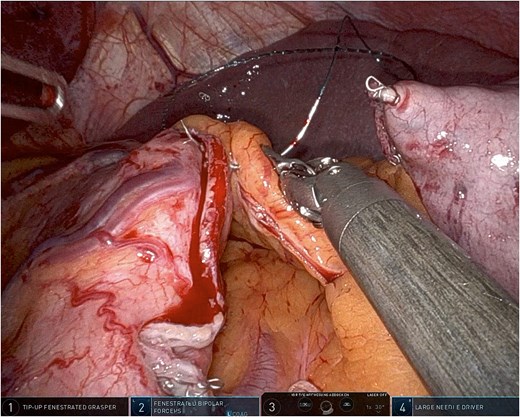 Robotic omentopexy during sleeve gastrectomy.