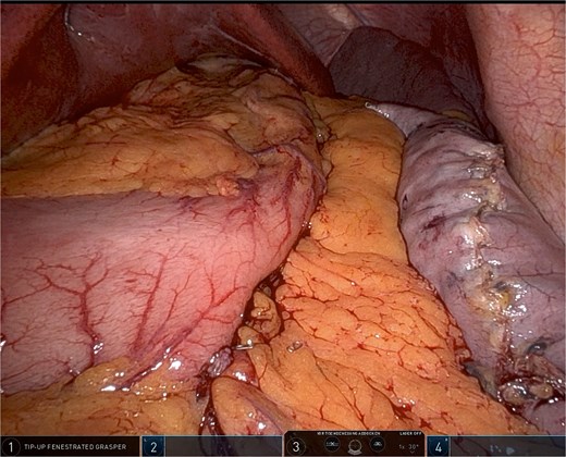 Robotic omentopexy after completion of sleeve gastrectomy.
