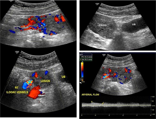 Showed ultrasonic images revealed a large vascular heterogenous supra-pubic mass, separable from the urinary bladder (UB), the peak systolic velocity within the mass = 41 cm/s.