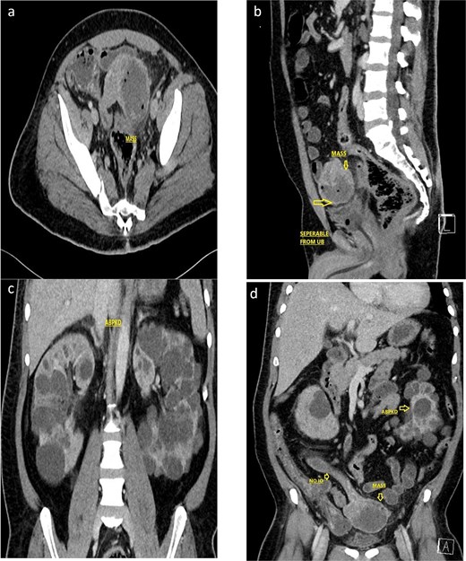 Contrast enhanced CT scan of the abdomen and pelvis (a, axial; b, sagittal) showed a 7.0 × 8.6 × 7.7 cm, exophytic mass having cystic and soft tissue components, a central hypodense area with air foci within, arising from the Jejunal loop, with mesenteric fat stranding and suspected intramural invasion. Associated findings included pericholecystic fluid, sub-centimetric mesenteric lymphadenopathy, subtle mesenteric fatty strandings, and bilateral renal cysts. Not associated with any intestinal obstruction or any obvious mesenteric tethering. The lesion is identified separable from the urinary bladder. (c, d) Coronal CT imaging showing the polycystic kidney disease.