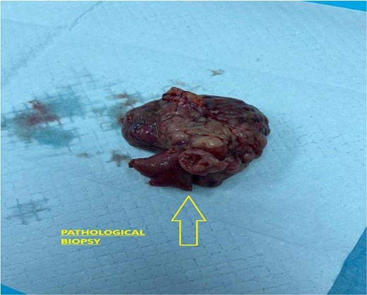 Showed gross specimen of the resected jejunal segment with extensive hemorrhage and central necrosis.