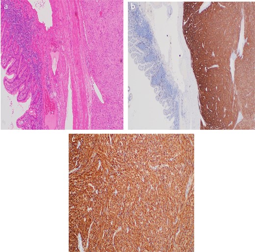 (a) Short intersecting fascicles of uniform spindle-shaped cells with pale eosinophilic cytoplasm and elongated nuclei. (b) Diffuse CD117 positivity. (c) X400 diffuse CD117 positivity.