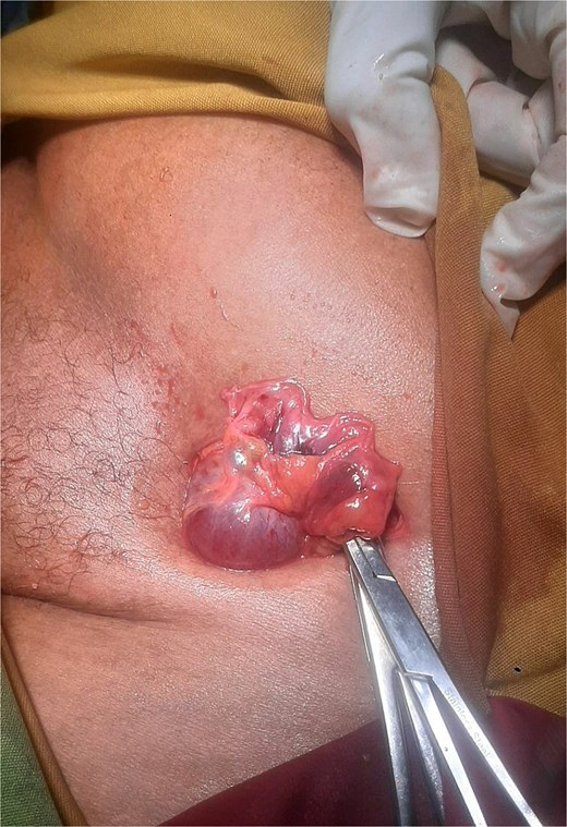 Intraoperative photograph demonstrating a left femoral hernia sac opened through a left inguinal incision, revealing a viable ovary and fallopian tube without evidence of ischemia or torsion, prior to reduction.
