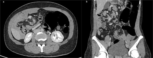 (a) Axial contrast-enhanced CT showing the classic ‘whirlpool sign,’ with clockwise swirling of the superior mesenteric vein and mesenteric fat around the SMA, consistent with midgut volvulus (b) coronal CT reconstruction confirming mesenteric torsion.