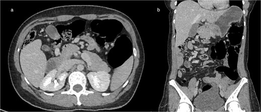 Axial (a) and coronal (b) contrast-enhanced CT images demonstrating intestinal malrotation, characterized by right-sided small bowel loops and left-sided colonic segments, with an abnormal relationship between the SMA and vein.