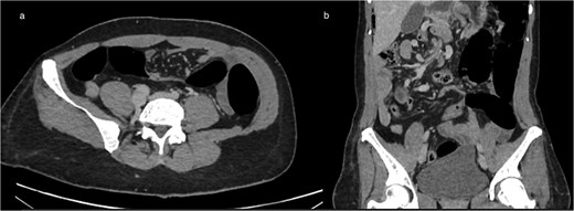 (a) Axial CT showing marked colonic distension upstream with an abrupt transition point in the right abdomen, consistent with mechanical obstruction related to volvulus (b) coronal CT reconstruction demonstrating colonic dilation and the corresponding transition zone.