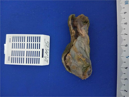 Alt-text: Gross image of an opened gallbladder specimen measuring about 7 cm, showing a segment of focal mural thickening in the body with otherwise smooth, greenish mucosa and no gallstones.