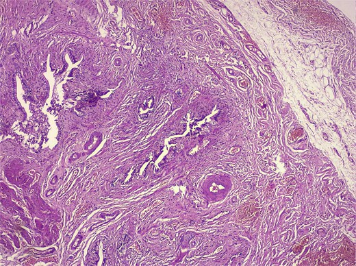 Alt-text: Low-magnification H&E image of the gallbladder wall showing mucosal diverticula penetrating the smooth muscle layer with chronic inflammatory stroma.