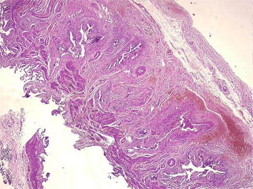 Alt-text: Medium-magnification H&E image showing glandular invaginations within hypertrophic smooth muscle bundles, consistent with adenomyosis, with chronic inflammatory stroma and trabecular bone formation.