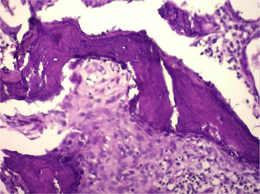 Alt-text: High-magnification H&E image showing irregular eosinophilic osteoid trabeculae with embedded osteocyte-like cells, characteristic of osseous metaplasia in the gallbladder wall.