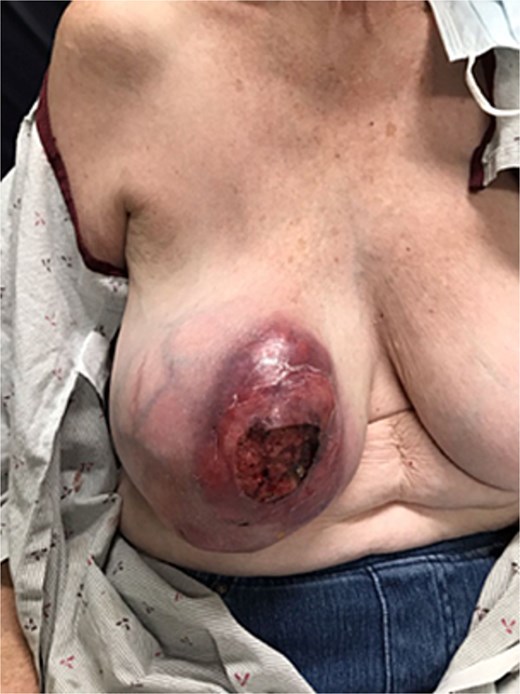 Patient's right breast on initial presentation demonstrates a large, firm, erythematous mass (~11 cm) with central ulceration and overlying skin thickening.