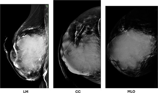 Diagnostic mammogram of the right breast demonstrates a mixed solid and cystic lesion in the central breast (BI-RADS 5), with extension to the nipple.