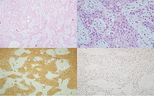Top left: Tumor cells arranged in cords and trabeculae infiltrate through the background breast stroma. Top right: Tumor cells have nuclear atypia and abundant eosinophilic cytoplasm consistent with squamous differentiation with surrounding desmoplastic stromal response and inflammation. Bottom left, bottom right: Diffuse positive cytoplasmic staining with CK5/6 and nuclear staining with p63, respectively.