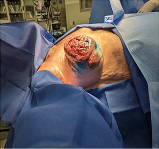 Preoperative image obtained before simple mastectomy with sentinel lymph node biopsy demonstrating rapid interval progression over a short two-week period, with marked increase in size, worsening skin involvement, and progression of ulceration.
