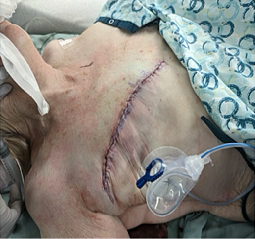 Post-operative flat closure incision after right simple mastectomy and sentinel lymph node biopsy.